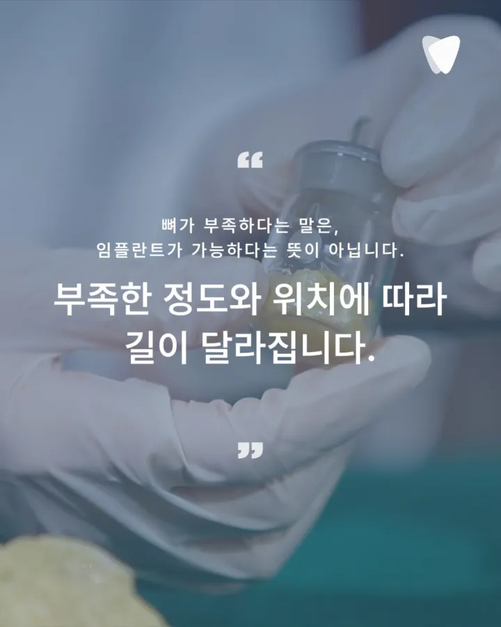 이미지 카드 · 임플란트 전 뼈가 부족하다는 진단, 정말 뼈이식이 꼭 필요할까?