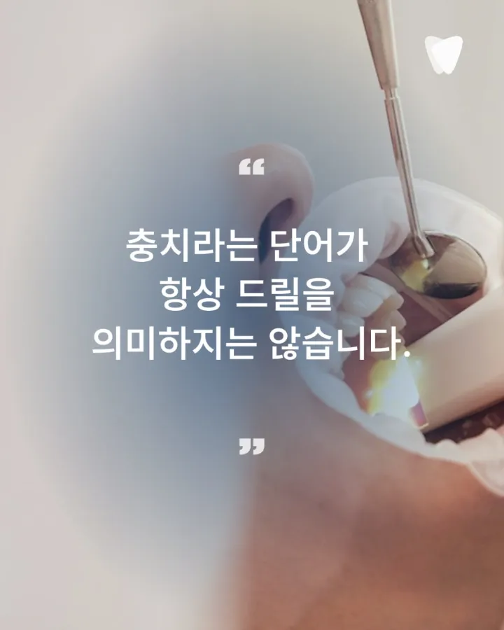 이미지 카드 · 초기 충치 레진 치료, 깎지 않고 지켜볼 수 있는 기준은 무엇인가