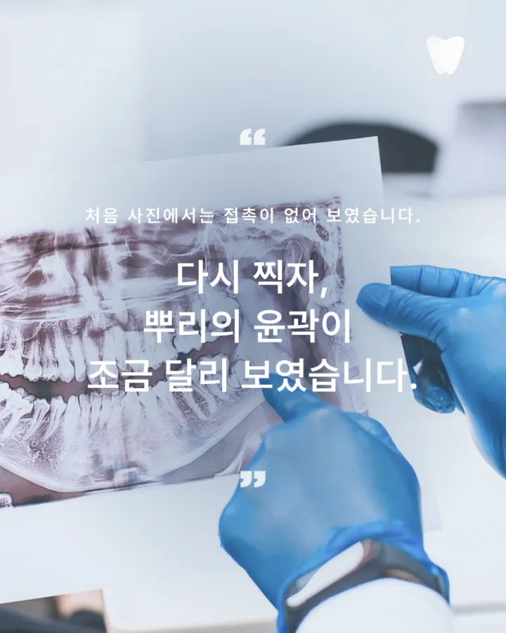 이미지 카드 · 사랑니 발치, 안 아프면 안 빼도 될까요? 판단 기준 정리