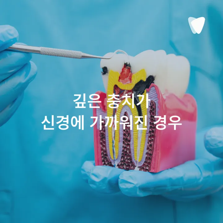 이미지 카드 · 어금니가 씹을 때 아픈 이유, 충치만 원인은 아닙니다