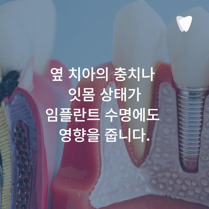 이미지 카드 · 운정 임플란트, 심는 것만큼 관리가 중요한 이유