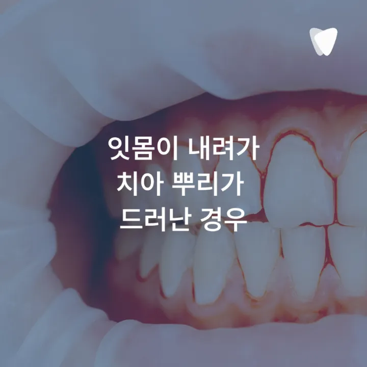 이미지 카드 · 찬물 마실 때 치아가 시린 이유, 충치 때문만은 아닙니다