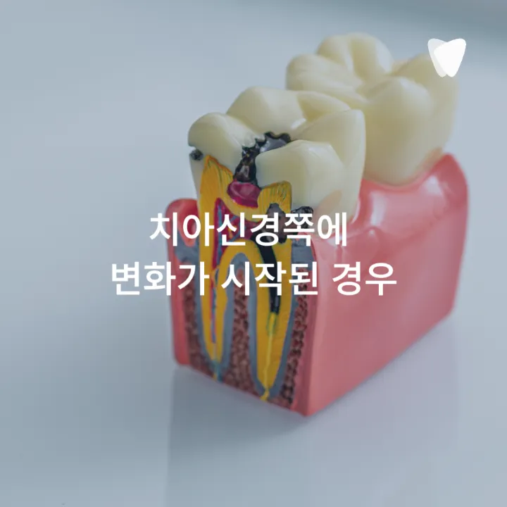 이미지 카드 · 찬물 마실 때 치아가 시린 이유, 충치 때문만은 아닙니다