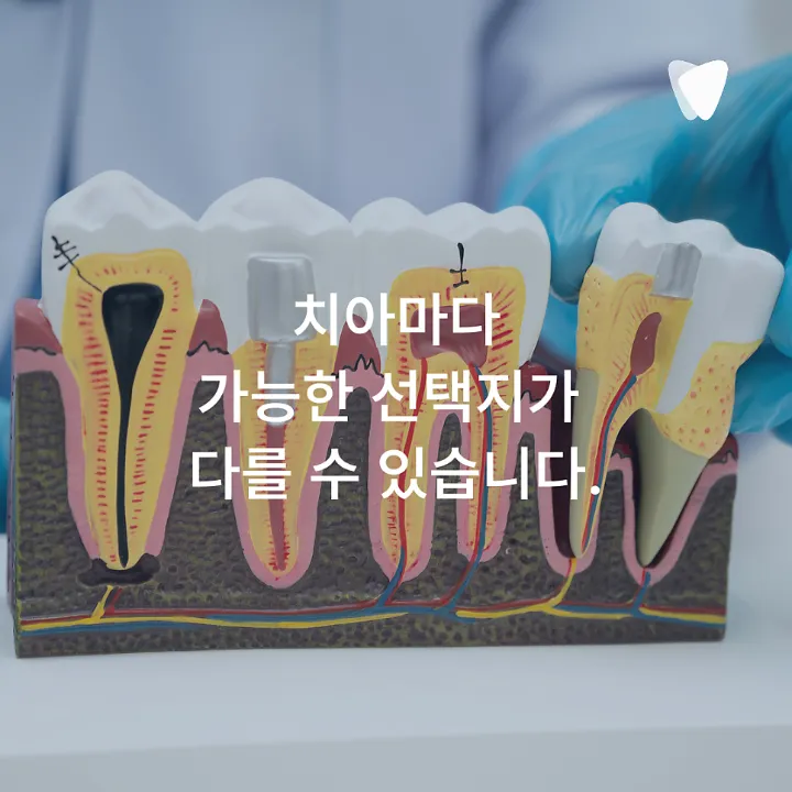 이미지 카드 · 운정 치아 뿌리 염증, 무조건 발치해야 할까요?
