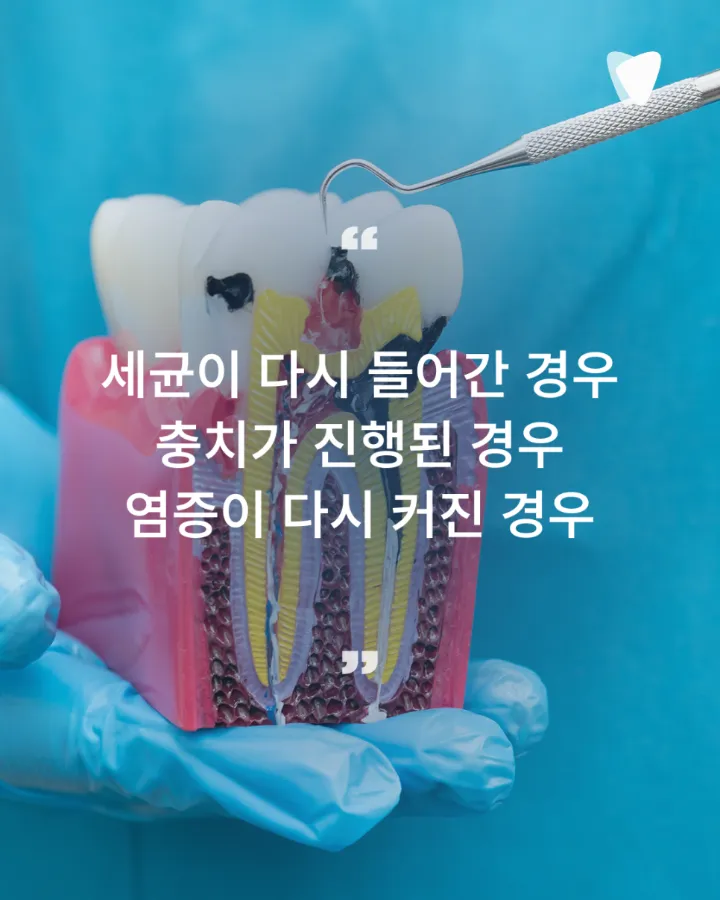 이미지 카드 · 재신경치료가 필요한 경우는 언제일까요?