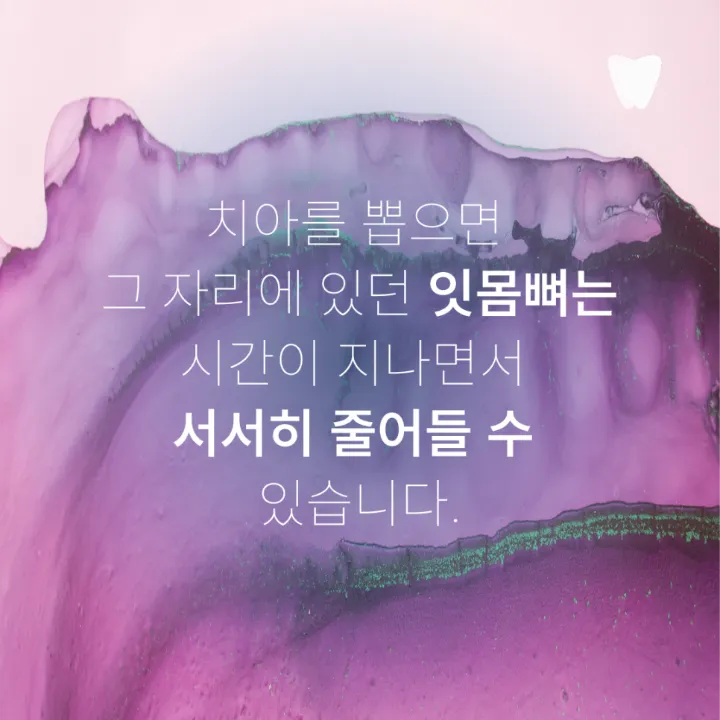 이미지 카드 · 임플란트 기간, 발치부터 보철까지 얼마나 걸릴까요?