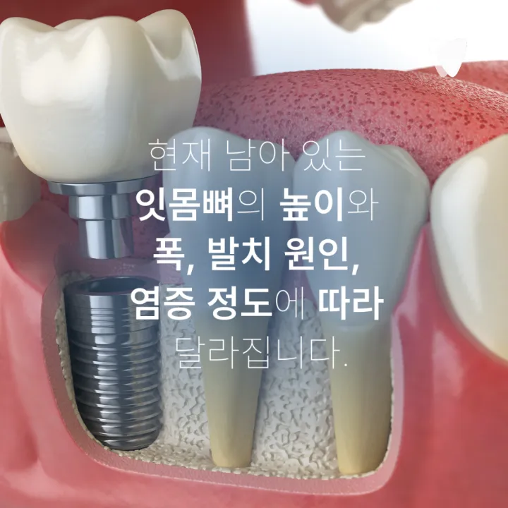 이미지 카드 · 운정 어금니 임플란트, 앞니 임플란트와 다른 점