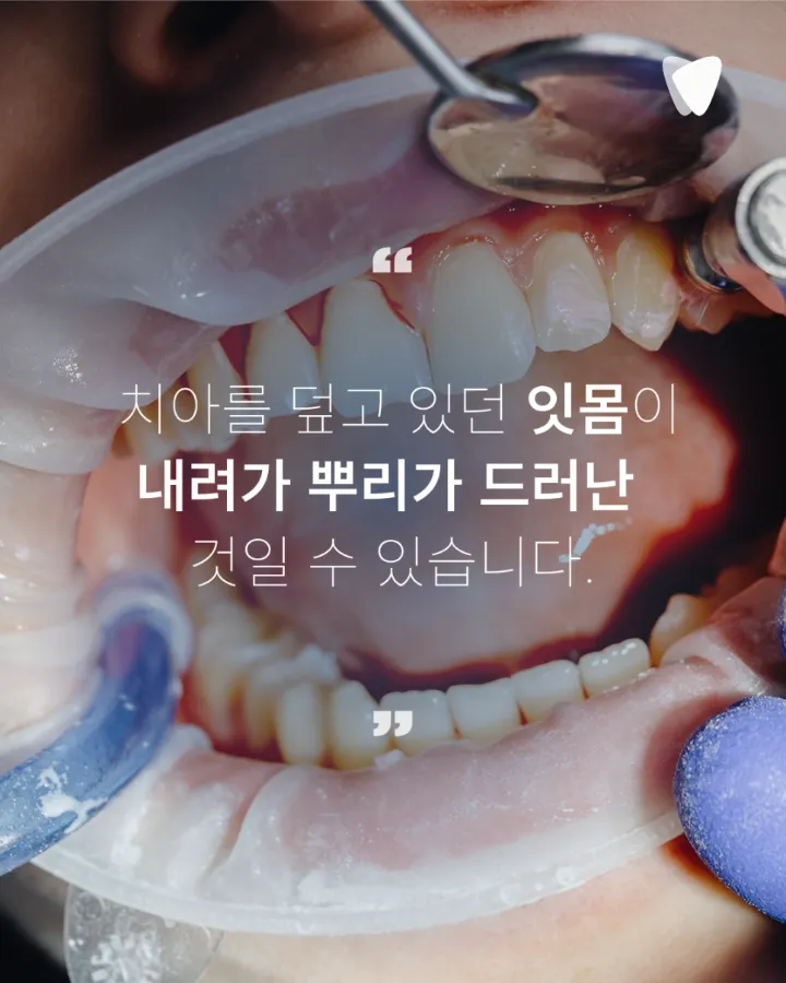 이미지 카드 · 치아가 길어 보이고 시리다면? 잇몸이 내려앉을 때 생기는 5가지 변화