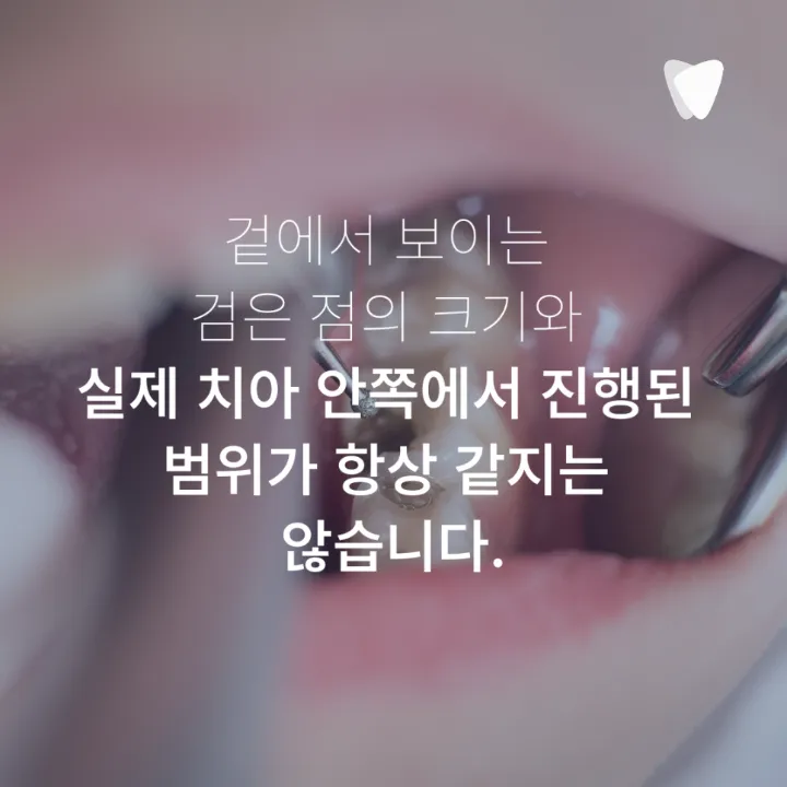 이미지 카드 · 치아의 검은 점은 모두 충치일까요? 착색과 구분하는 방법