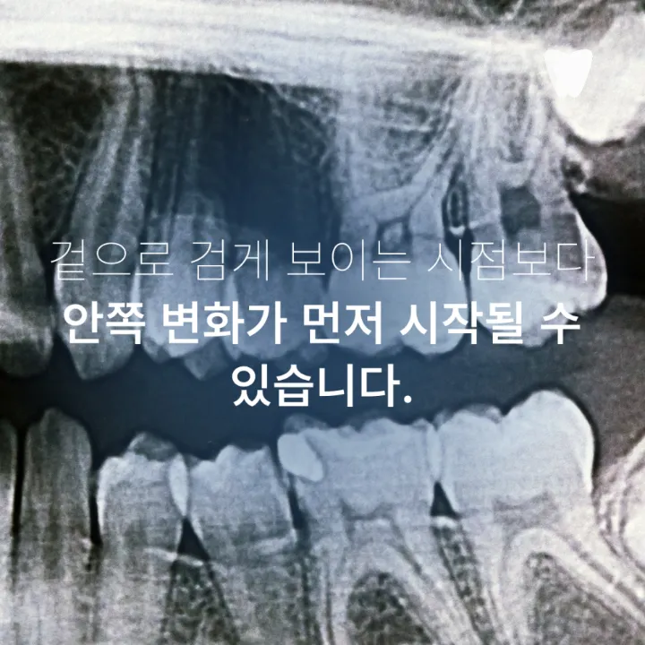 이미지 카드 · 치아의 검은 점은 모두 충치일까요? 착색과 구분하는 방법