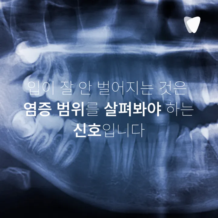 이미지 카드 · 사랑니 주변 잇몸이 붓고 입이 잘 안 벌어지는 이유