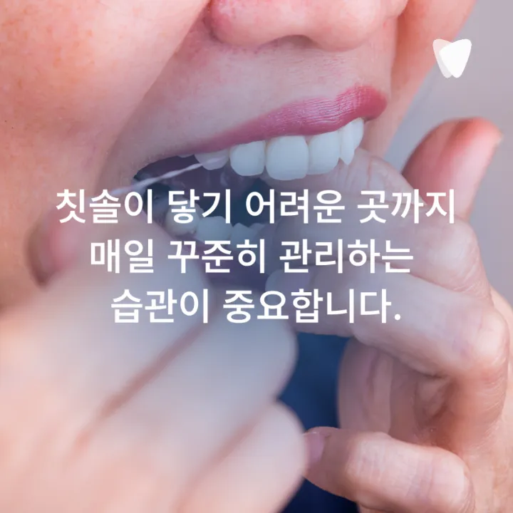 이미지 카드 · 임플란트 수명, 오래 쓰는 분들의 공통점은 무엇일까요?