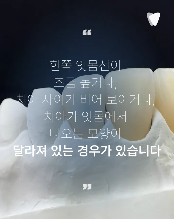 이미지 카드 · 앞니 임플란트, 잇몸 라인까지 봐야 하는 이유