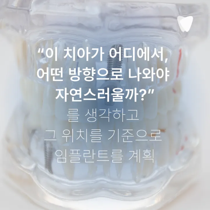 이미지 카드 · 앞니 임플란트, 잇몸 라인까지 봐야 하는 이유