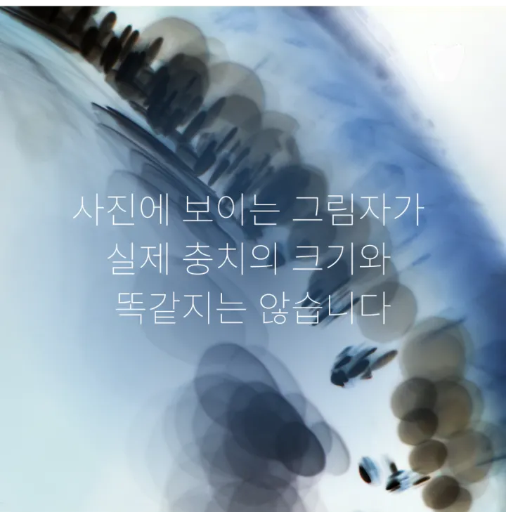 이미지 카드 · 치아 사이 충치는 왜 엑스레이에서 먼저 보일까요?