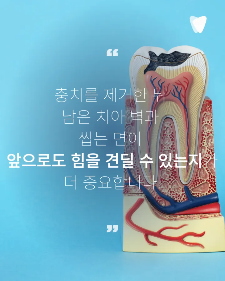 이미지 카드 · 레진·인레이·크라운, 충치 치료 방법이 달라지는 기준