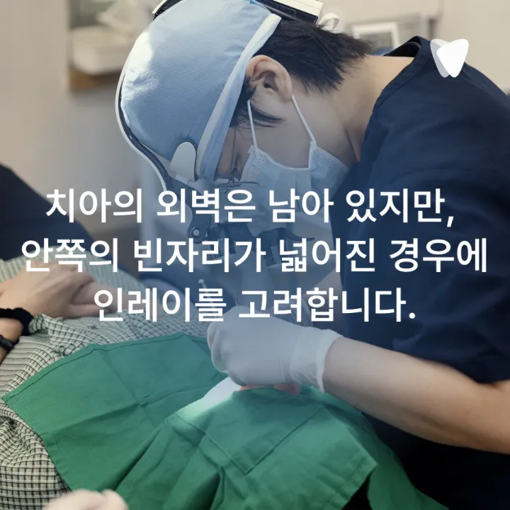 이미지 카드 · 레진·인레이·크라운, 충치 치료 방법이 달라지는 기준