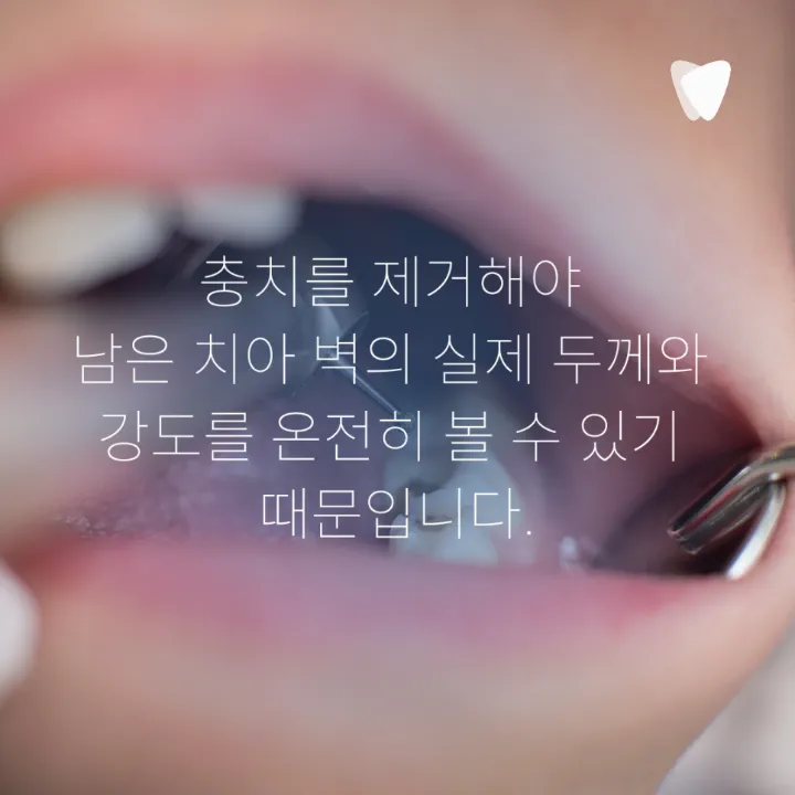이미지 카드 · 레진·인레이·크라운, 충치 치료 방법이 달라지는 기준