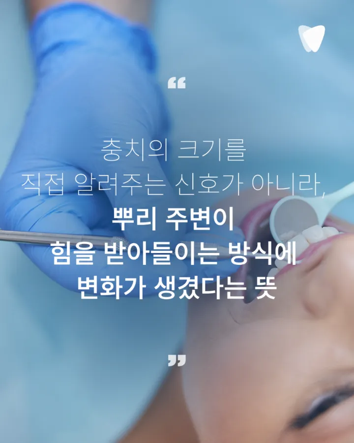 이미지 카드 · 치아를 톡톡 두드렸을 때 아픈 이유, 뿌리 주변 염증을 살피는 이유