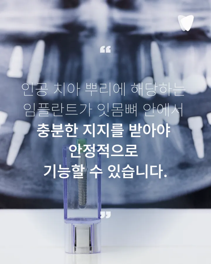 이미지 카드 · 상악동 거상술, 위 어금니 임플란트에서 필요한 경우
