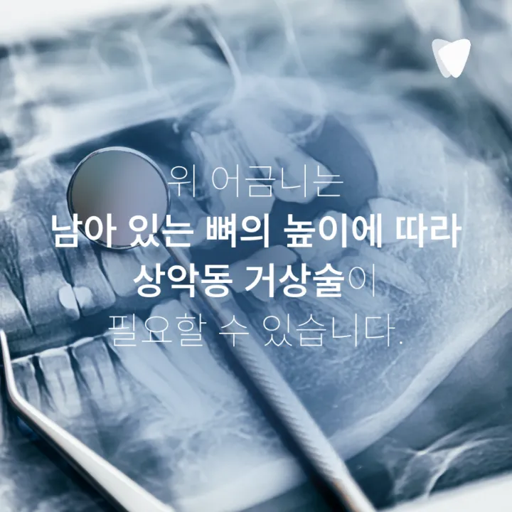 이미지 카드 · 임플란트 뼈이식 비용, 같은 뼈이식인데 왜 다를까요?