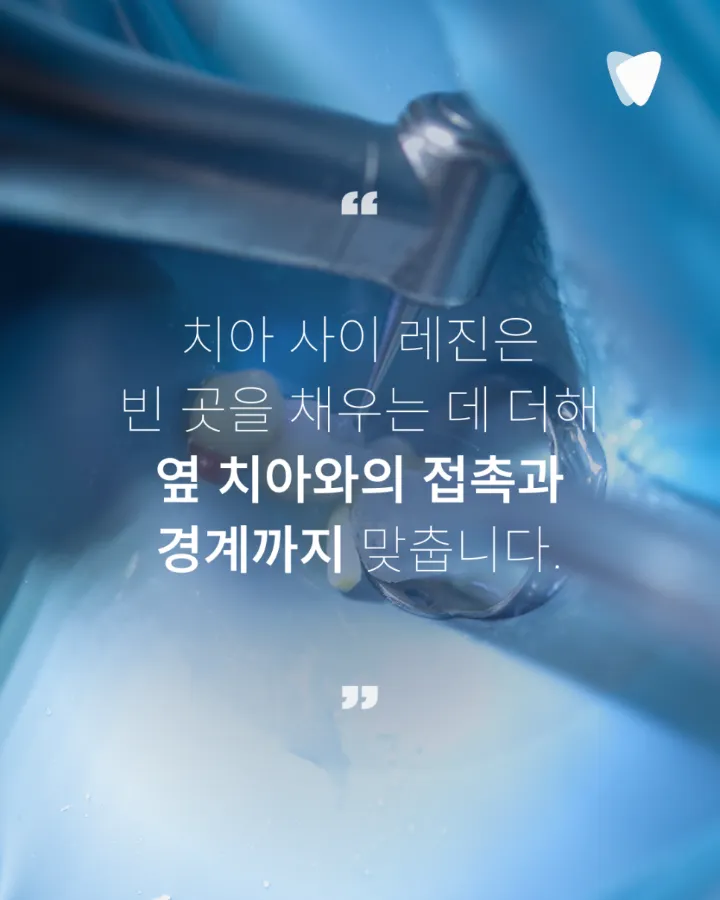 이미지 카드 · 레진 치료 비용이 치아마다 다른 이유: 치료 면·위치·접착 조건