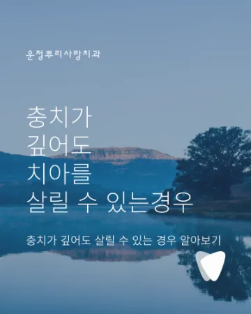 충치가 깊어도 치아를 살릴 수 있는 경우