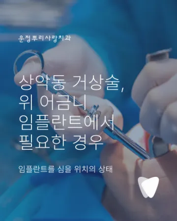 상악동 거상술, 위 어금니 임플란트에서 필요한 경우